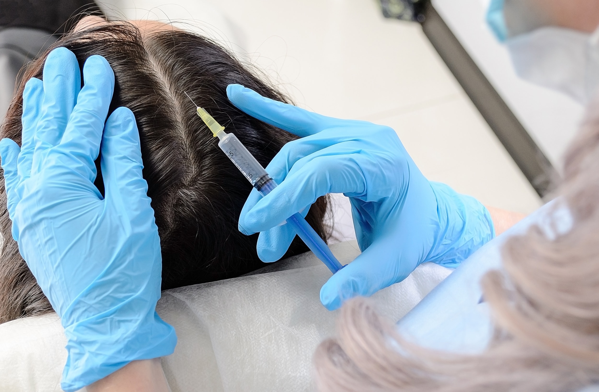 Мезотерапия для волос москва. Мезо волосистой части головы. PRP-терапия (плазмотерапия) для волос. Плазмотерапия волосистой части головы. Мезо hair.