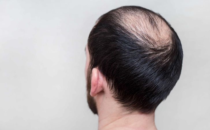 頭頂部 側頭部の薄毛対策は 生え際の髪を後退から守ろう 薄毛 抜け毛研究所