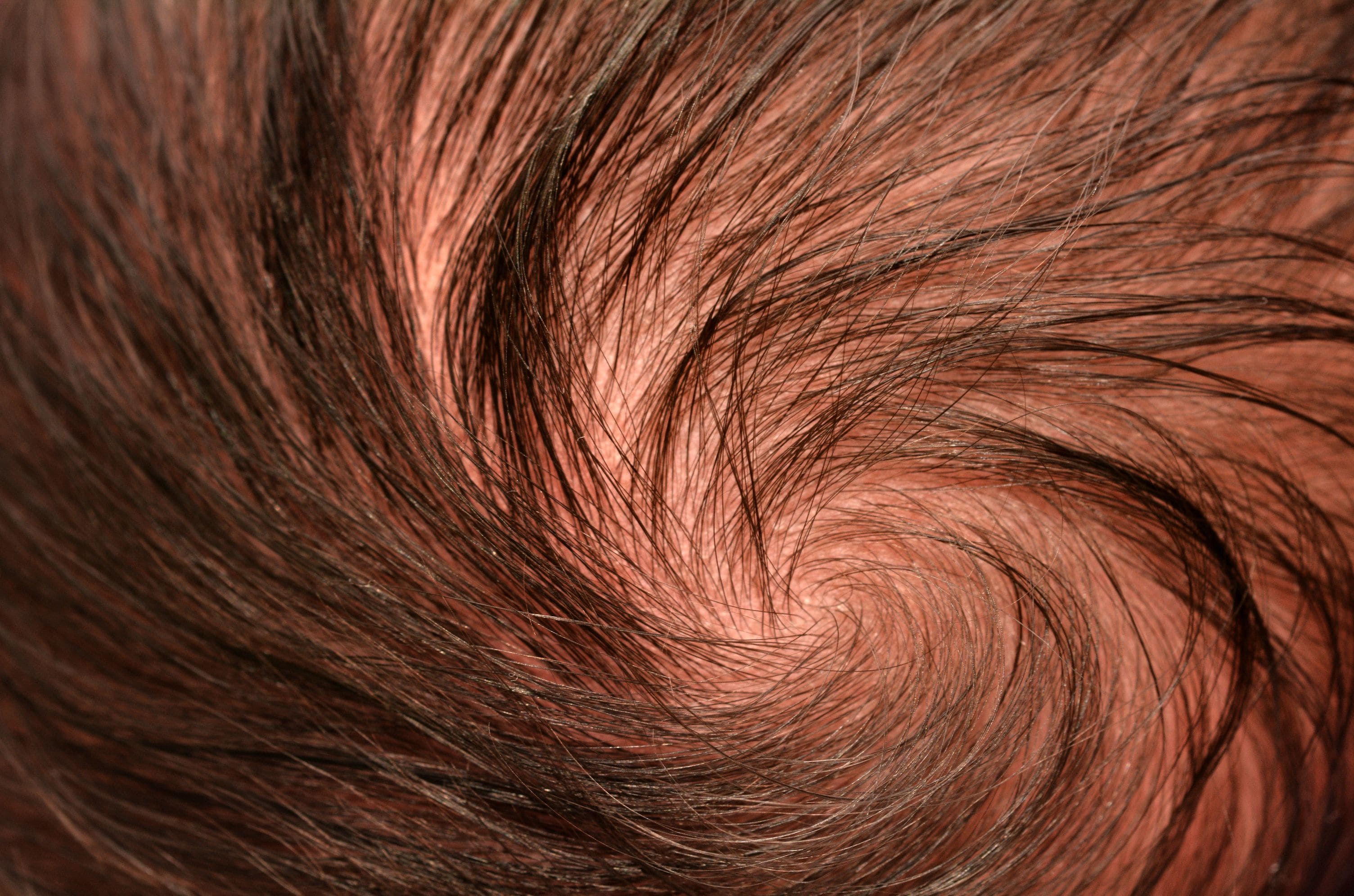 頭皮が赤い原因は血行不良 炎症のリスクや改善方法 薄毛 抜け毛研究所
