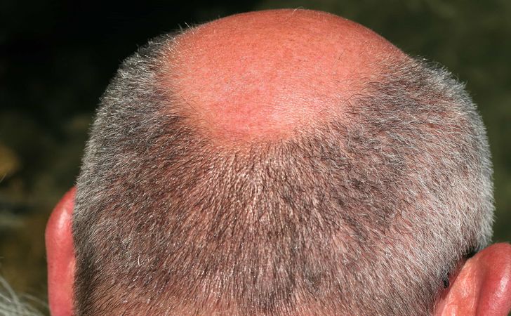 頭皮の日焼けを予防しよう 抜け毛を抑えるケア方法は 薄毛 抜け毛研究所