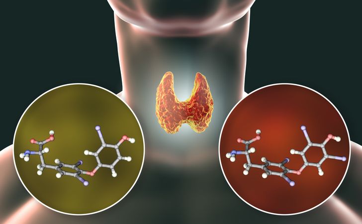 甲状腺機能低下症