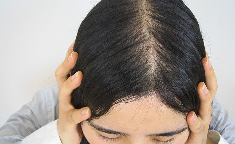 薄毛で悩む女性に つむじや分け目をカバーするヘアテク9選 視覚的に増毛が可能なスーパーミリオンヘアー 薄毛 抜け毛研究所