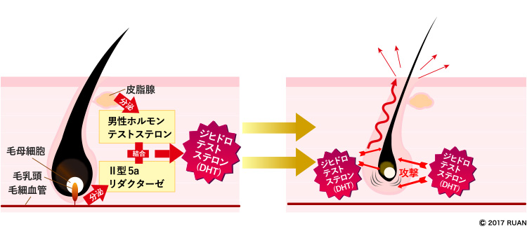 5α-リダクターゼ+テストステロン=ジヒドロテストステロン