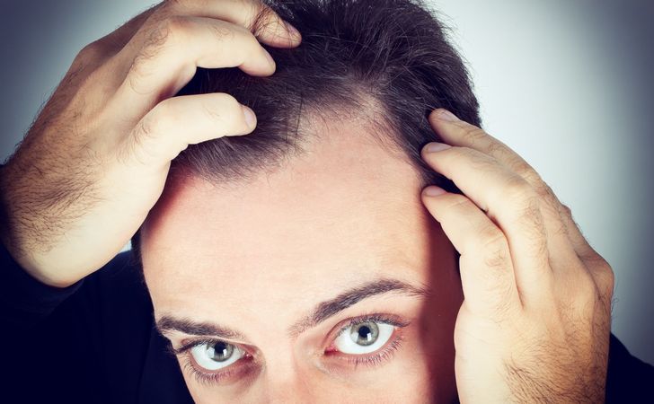 生え際が気になる男性