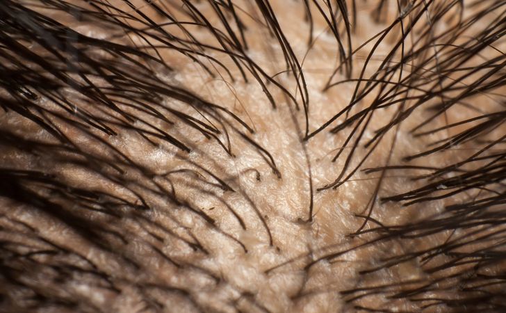 頭皮の臭いの原因